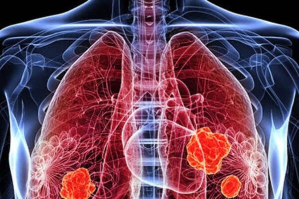 1 out of every 3 thousand people are at risk of hole in lungs, due to the risk of kidney cancer, scientists caught the reason for this