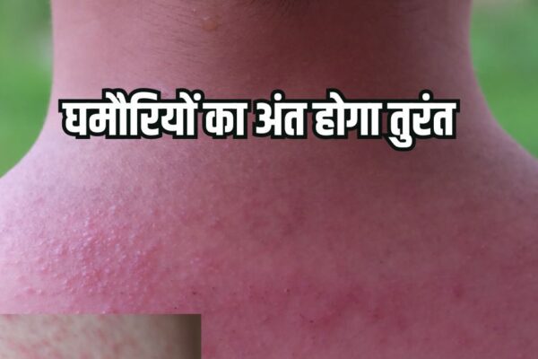 Home Remedies for prickly heat: 5 home remedies to avoid prickly heat in summer