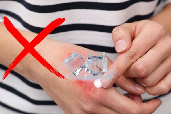 Burn injury treatment do not apply ice: First aid on burning: Doctor Agni Bose advice.