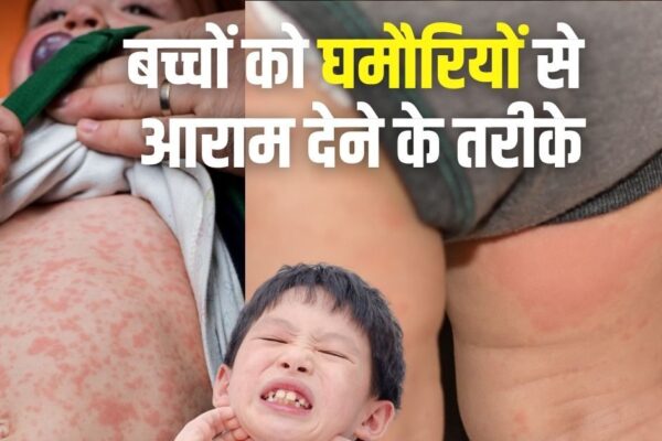 Treatment of prickly in children: home remedies and methods of prevention.