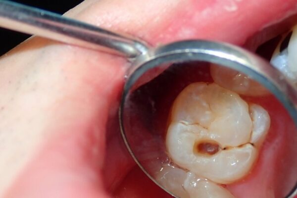Tips to get rid of cavities and tooth pain: How to get rid of teeth and pain? Learn very easy ways