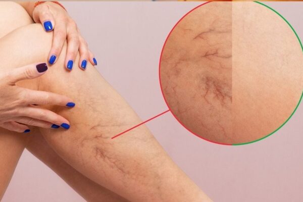 Varicose veins symptoms and prevention tips | Varicose veins: causes, symptoms and prevention measures