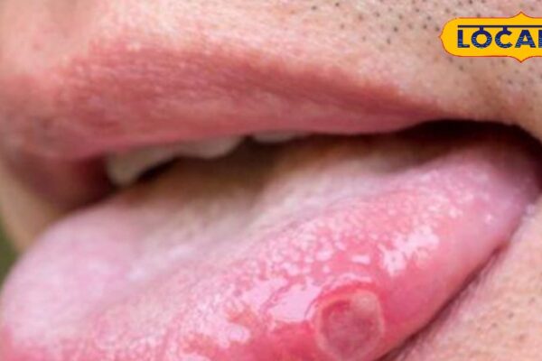 Mouth blisters, tingling and swelling will disappear as soon as they apply, this thing of kitchen is effective in mouth ulcers