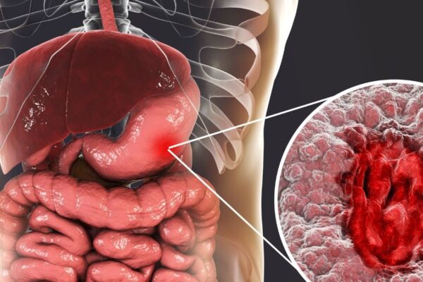 Pain Killer Increase Risk of Stomach Ulcer-Statches on your intestines pen killer medicines