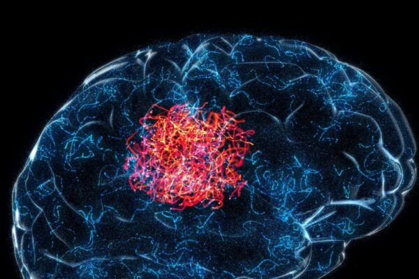 Early Sign and Symptom of Brain Tumor | These 7 warning signals of brain tumor