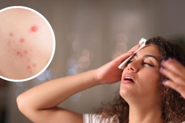 How Handkerchief Causes Skin Infections: Wiping of sweat with handkerchiefs in summer and monsoon is the risk of skin infection