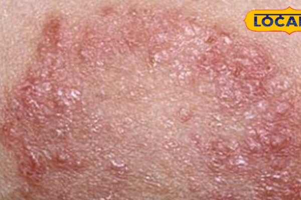 In the rainy season, the risk of ringworm and itching increases, know tips to prevent this