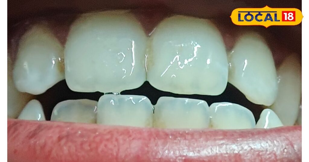 Ayurvedic remedies for teeth whiteness: Suggestions of Bhuvanesh Pandey.