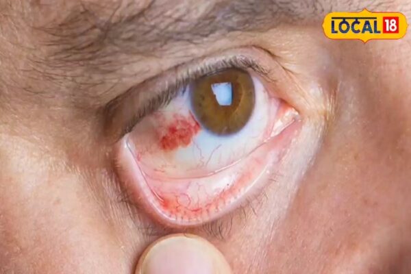 Will be blind! This dangerous infection spreads in the rain, these people are more threatened