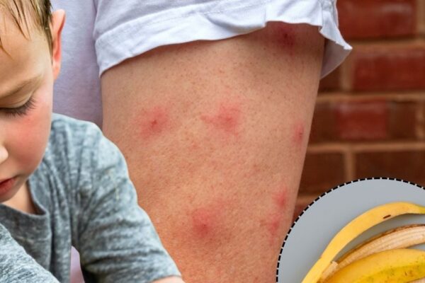 Mosquito Bite Home Remedy: Is there a burning sensation on the skin as soon as the mosquito bites? Instant will provide banana peel, learn way