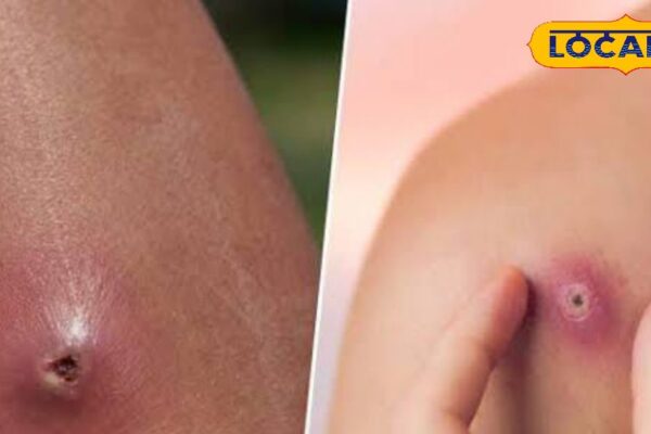 Health Tips: If you are upset with boils and pimples in rain, then adopt this domestic trick, will get relief quickly