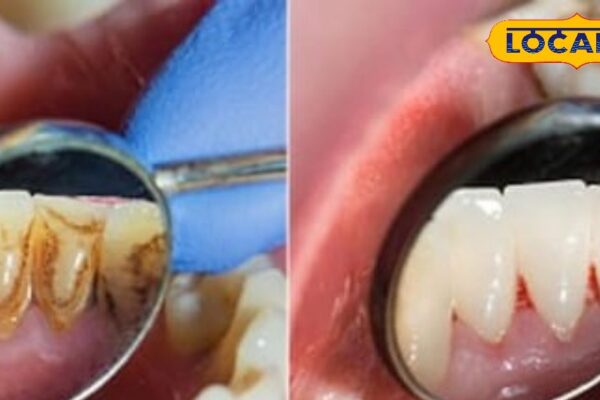 Tips and Tricks: Troubled by toothache …? This thing of the kitchen will be done by the panacea, you will get rest in minutes!
