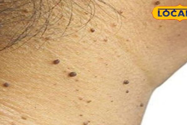 Health Tips: If you are disturbed by warts, then these domestic and cheap tips will work, know easy remedies – uttar pradesh news