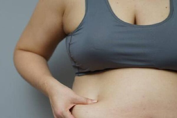 Stubborn obesity is not decreasing, so much to get surgery right? Can anyone get it done? Dr.