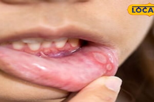 Health Tips: Mouth ulcers are disturbed, try these home remedies, will get immediate rest