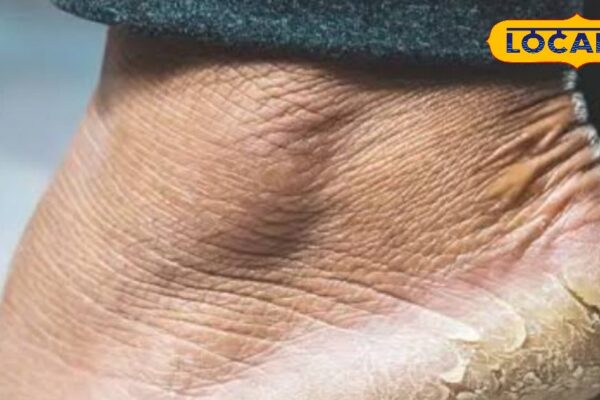 If you want beautiful and soft legs, then adopt these 6 easy tips, you will get rid of torn ankles