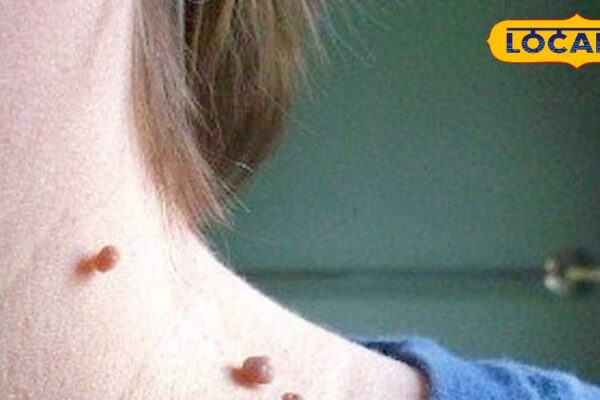 Health Tips: Year -old wart will fall, adopt these 6 home remedies to remove; Get rid of in a few days – Uttar Pradesh News